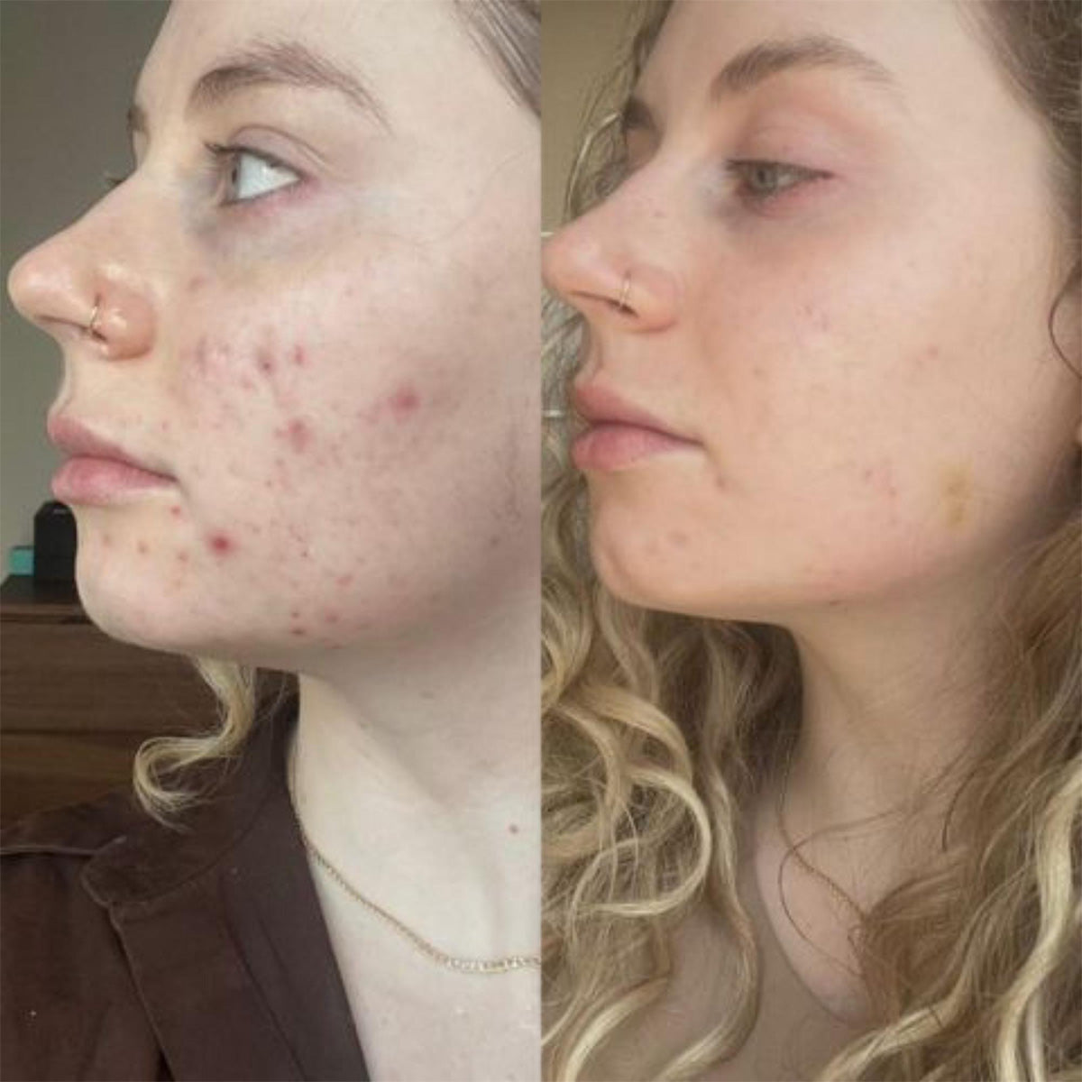 AO2 Skin AO2 Clear before and after results