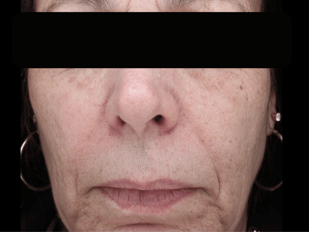 After BBL treatment: same face with reduced sun spots and more even skin tone