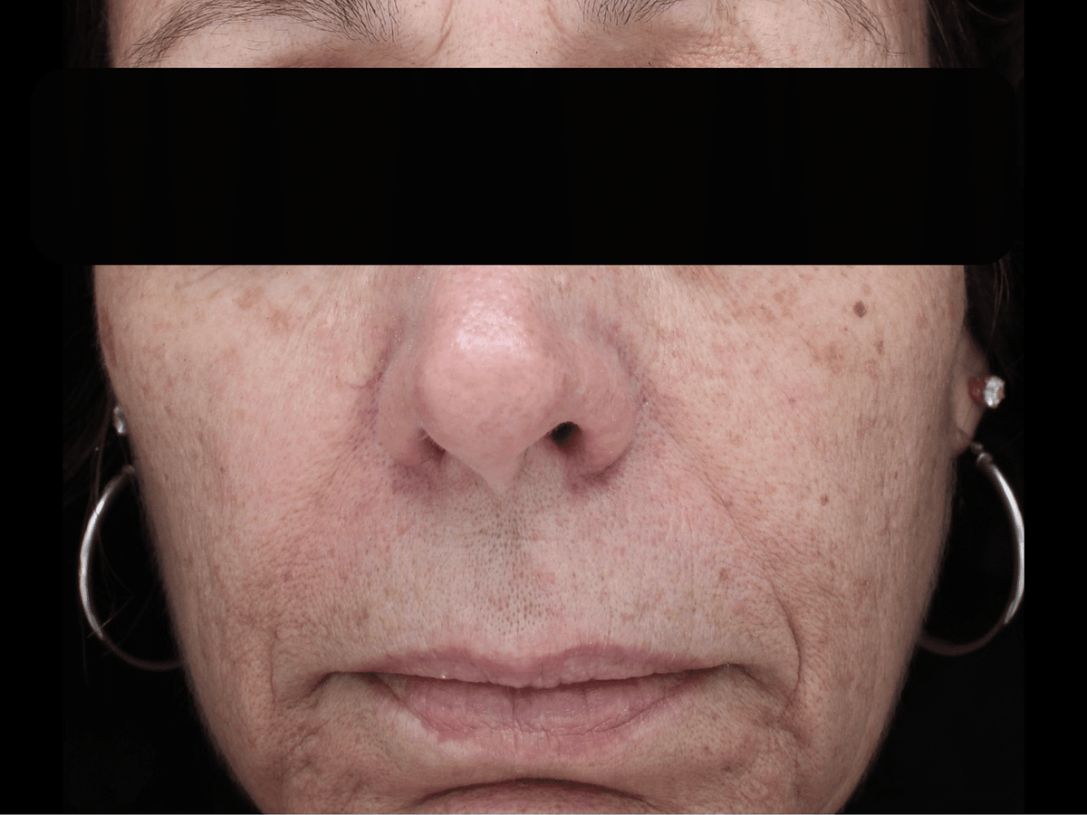 Before BBL treatment: face with sun spots, uneven tone, and visible pores
