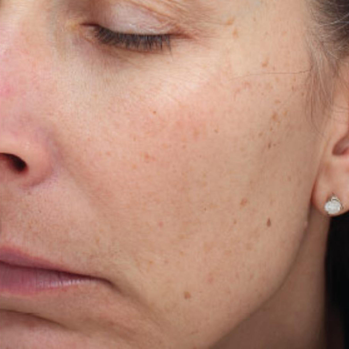 Epionce Intensive Nourishing Cream after treatment