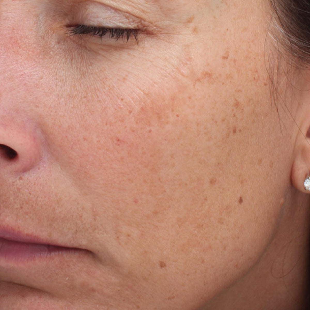 Epionce Intensive Nourishing Cream before treatment