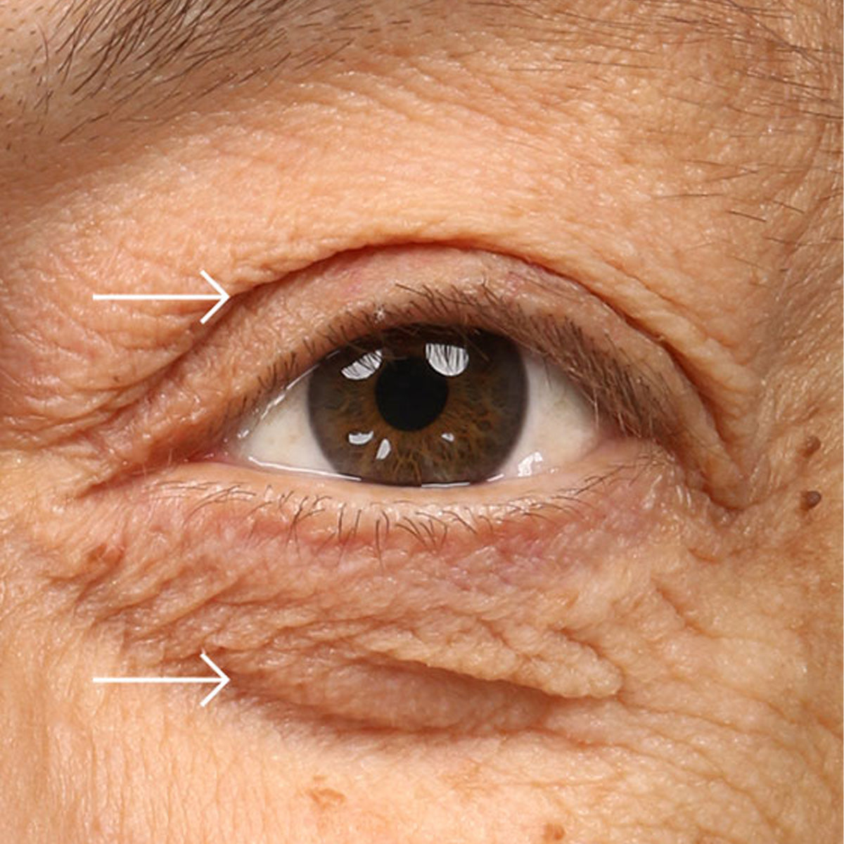 Epionce Renewal Eye Cream before treatment