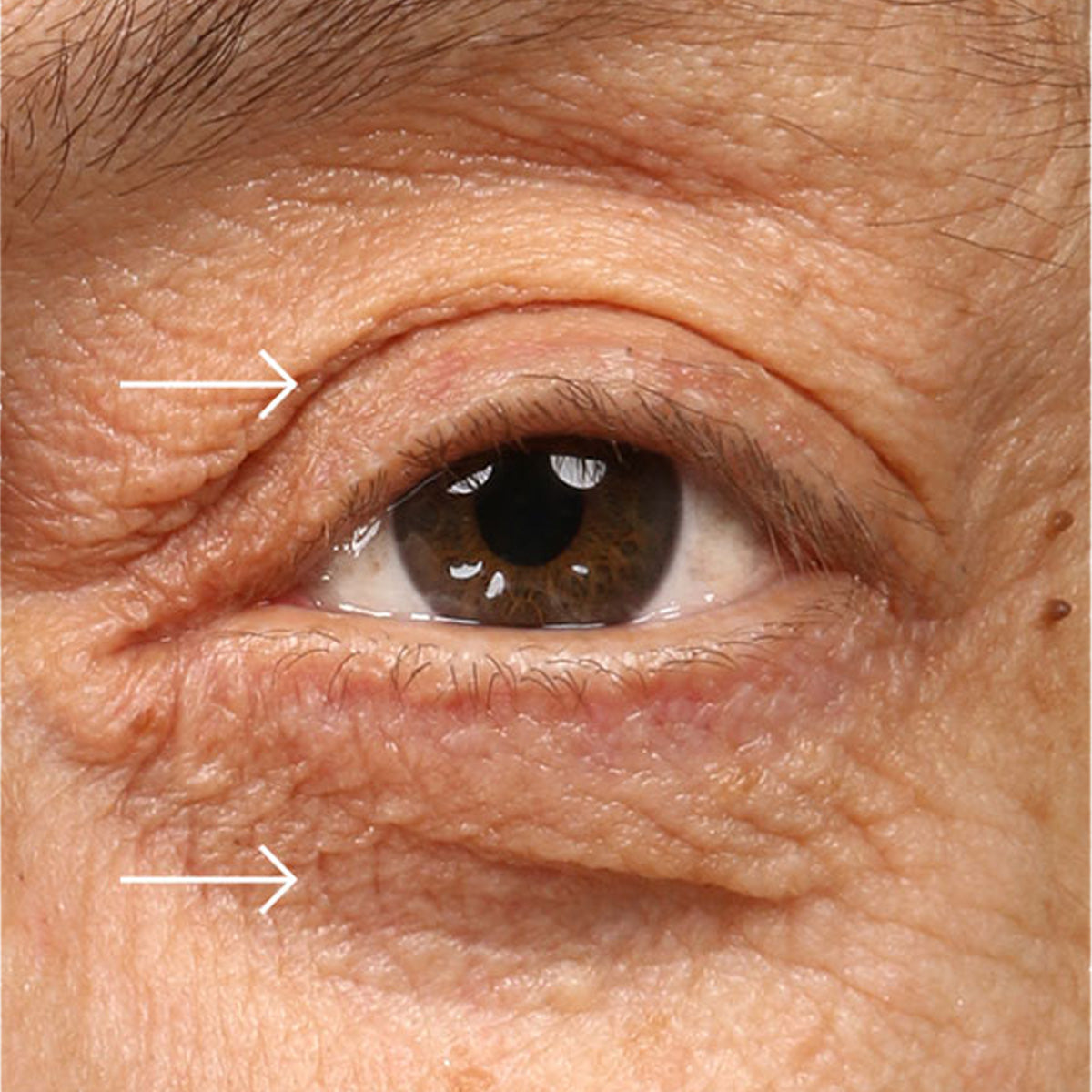 Epionce Renewal Eye Cream after treatment