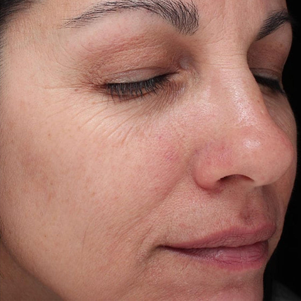 Epionce Renewal Facial Cream before treatment