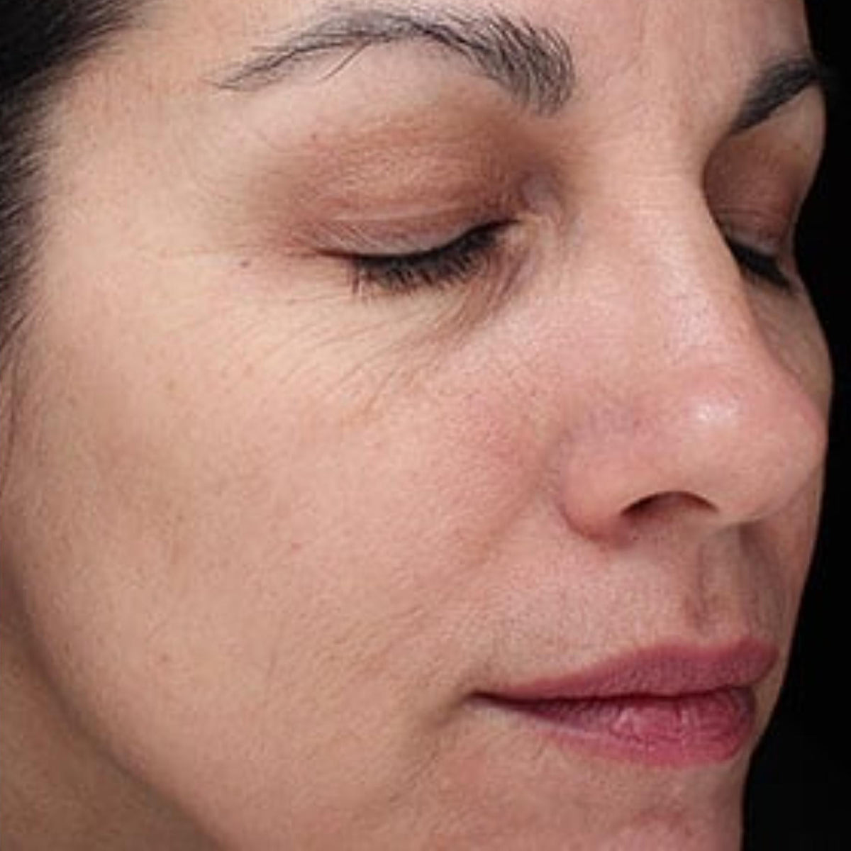 Epionce Renewal Facial Cream after treatment