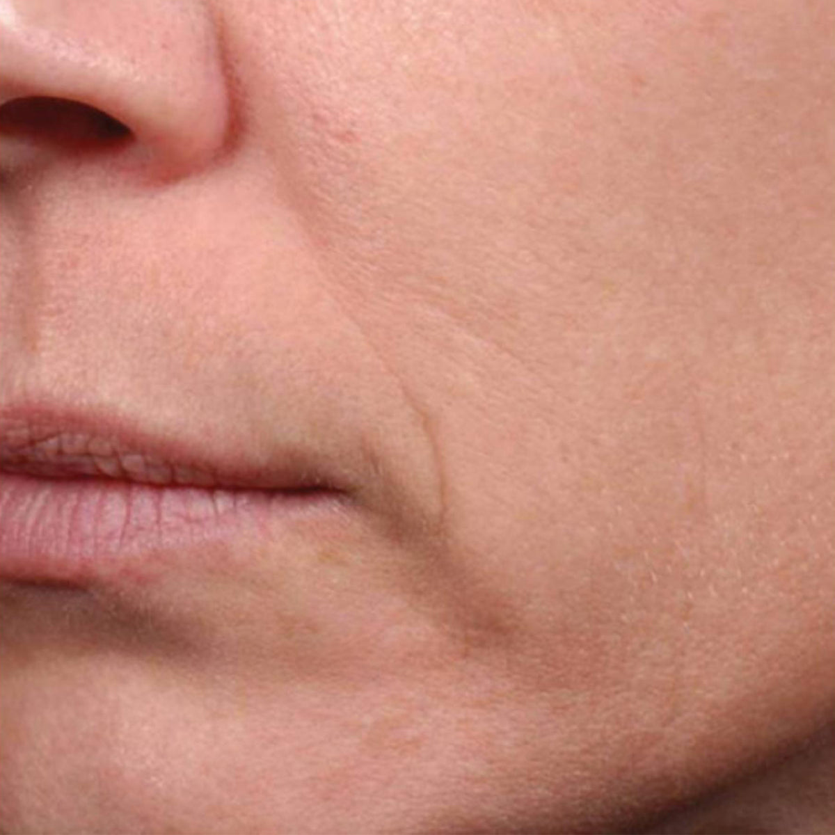 Epionce Renewal Facial Lotion before treatment