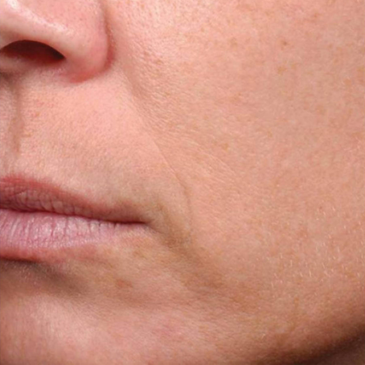 Epionce Renewal Facial Lotion after treatment