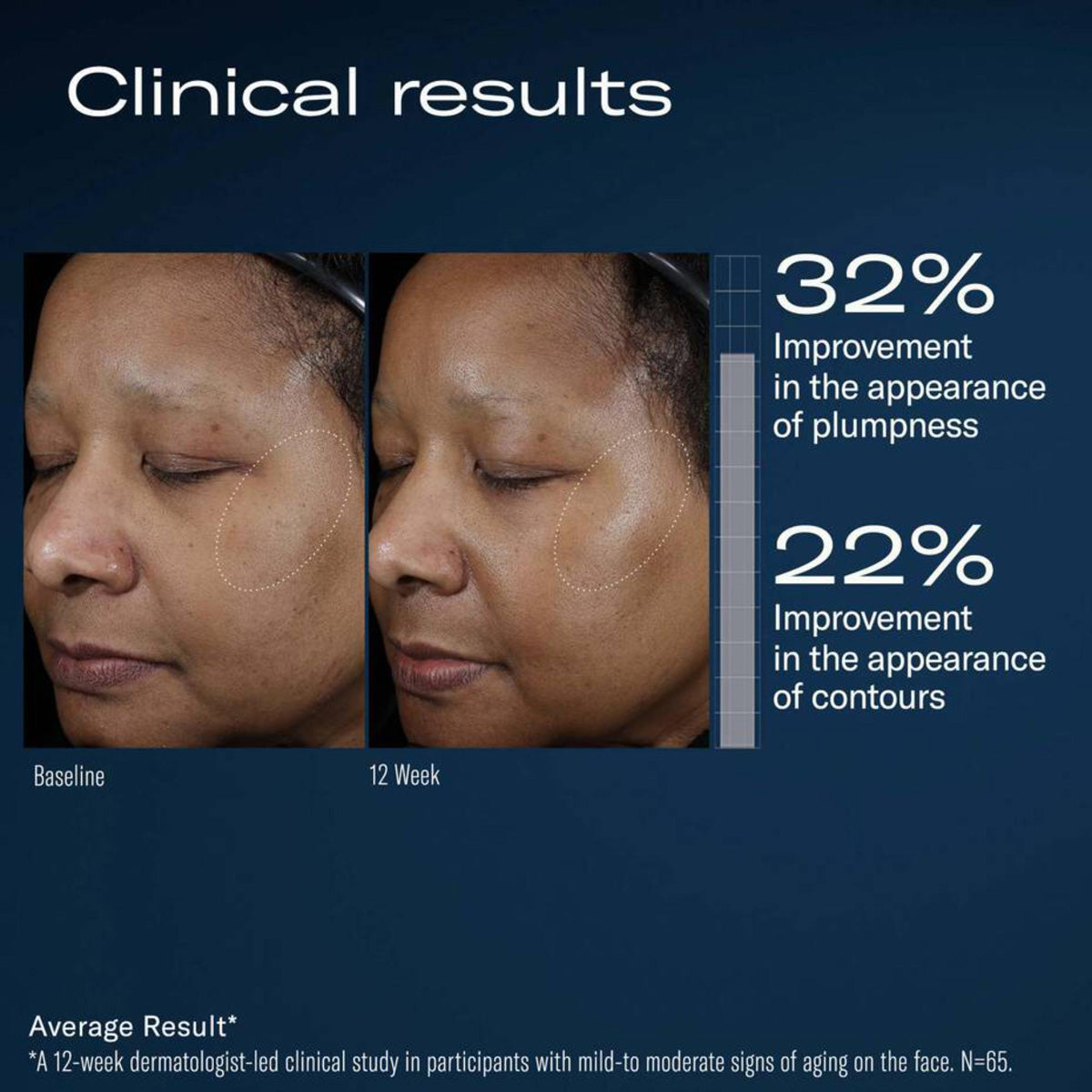 Skinbetter Science Ampra Volumizing Macro HA Serum before and after results